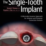 The Single-Tooth Implant: A Minimally Invasive Approach for Anterior and Posterior Extraction Sockets 1st Edition
