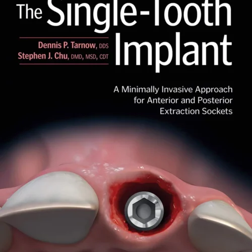The Single-Tooth Implant: A Minimally Invasive Approach for Anterior and Posterior Extraction Sockets 1st Edition