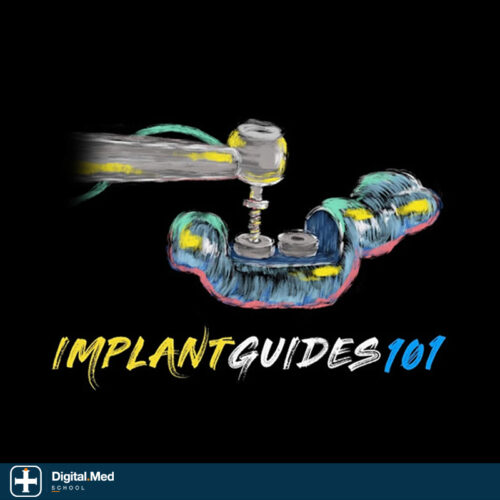 Implant Ninja — Implant Guide 101