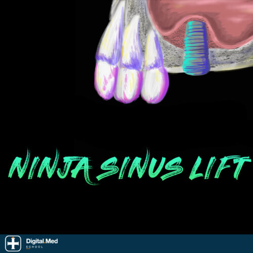 Implant Ninja — Sinus Lifting Masterclass
