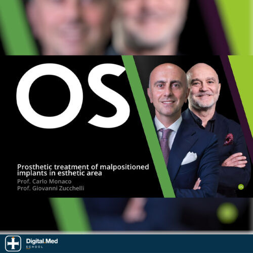 Prosthetic Treatment of Malpositioned Implants — Osteocom